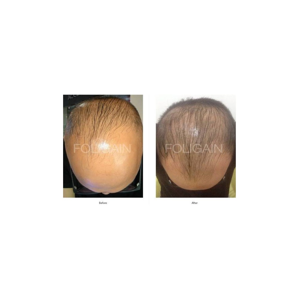 FOLIGAIN Sampon pentru regenerarea parului pentru barbati 2% Trioxidil® (8oz) 236ml Sampon pentru regenerarea parului la barbati