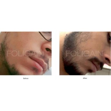 Foligain Minoxidil 5% Solutie cresterea parului barbati (Alcool scazut) 3 luni Beneficii Foligain Minoxidil: in mod eficient opr