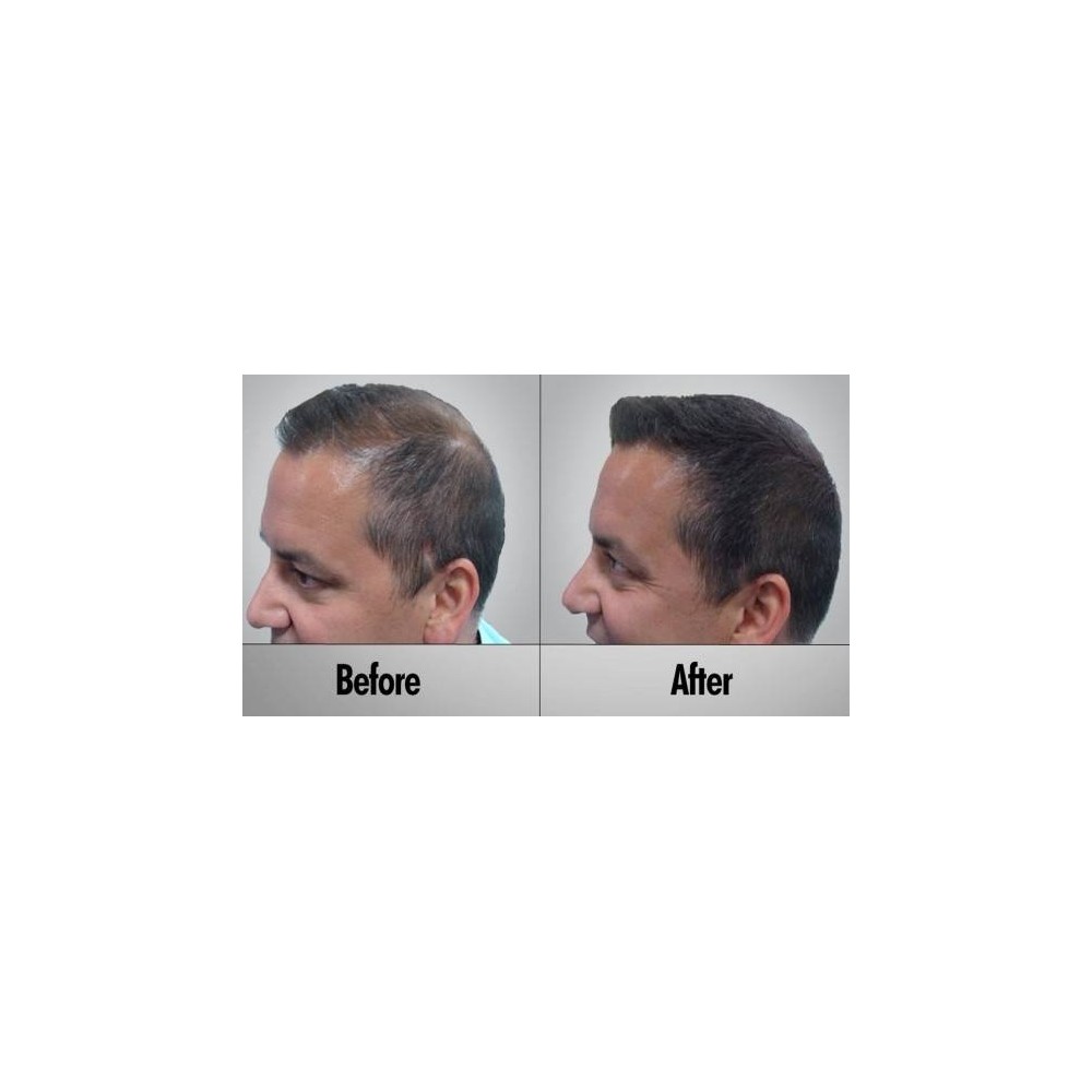 Foligain set tripla actiune, pentru caderea parului la barbati, Sampon, Balsam si Lotiune Kit Trioxidil tratamentul anti caderea